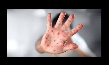8 casos de viruela del mono en Argentina – Síntomas y prevención